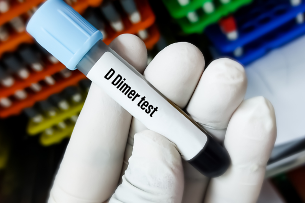 d-dimère et stress que faire