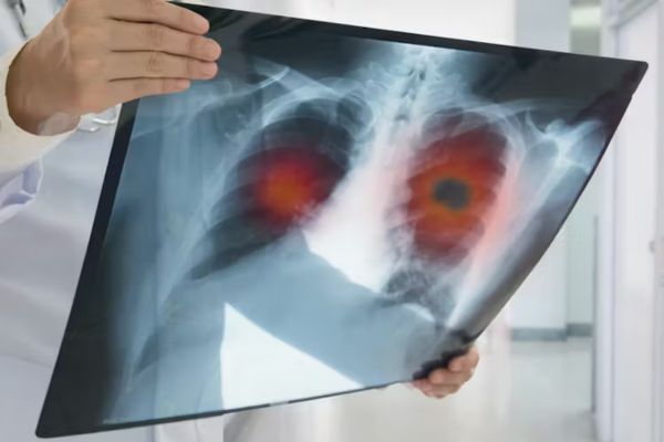 dépistage du cancer du poumon chez les fumeurs