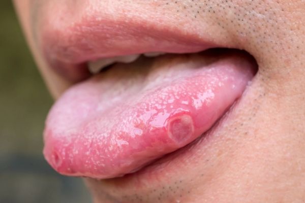 bouton sur la langue remède naturel