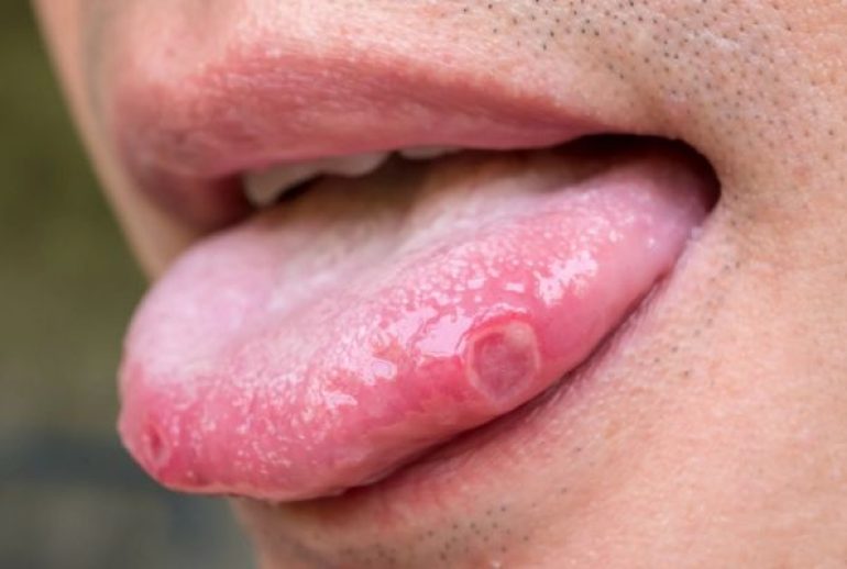 bouton sur la langue remède naturel